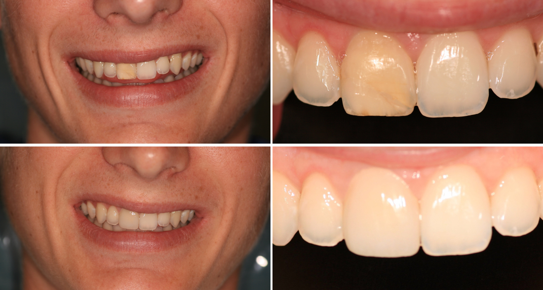 Harlingen Dentistry Blog Front Tooth Makeover