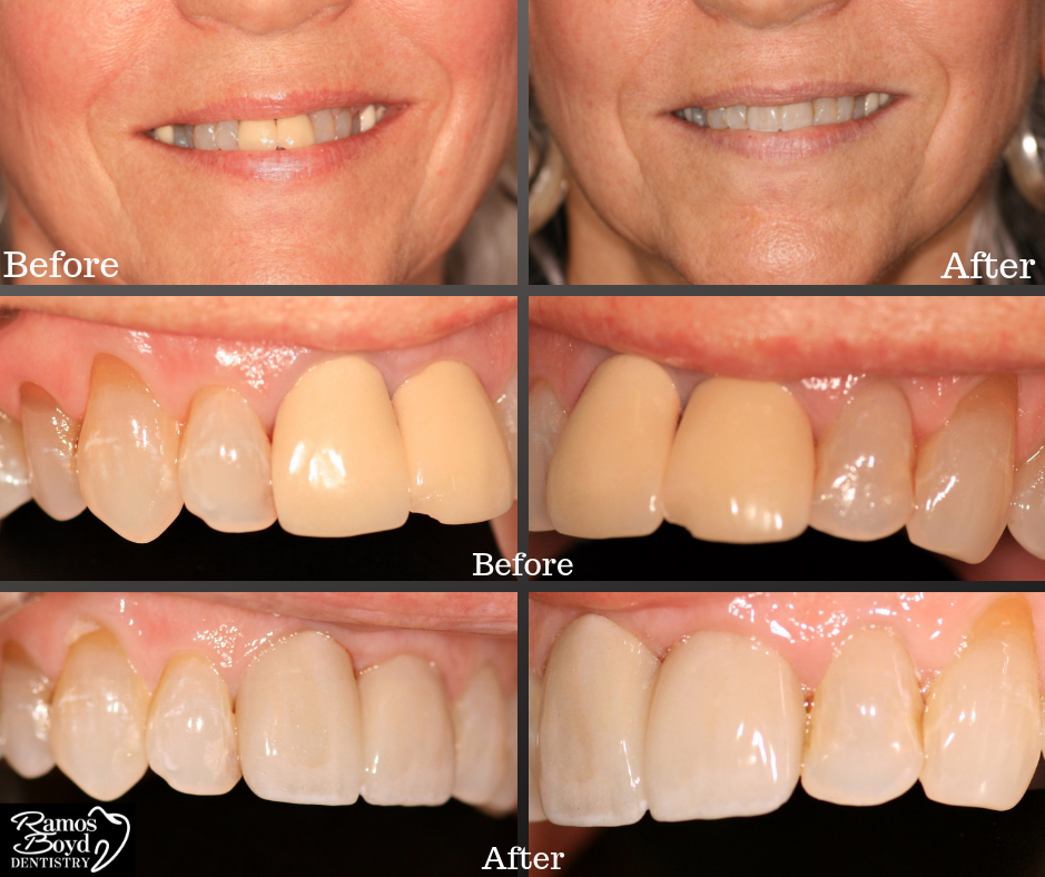 Replacing existing crowns Cosmetic Dentistry Harlingen TX