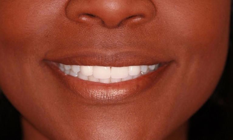 Anterior-Crowns-Part-1-After-Image