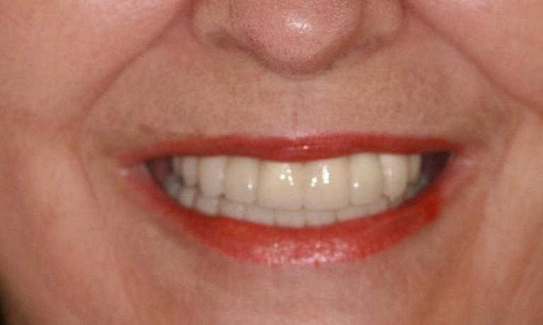 Dental-Implants-Case-1-After-Image