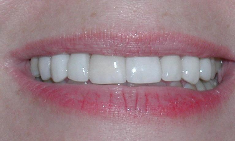 Porcelain-Veneers-Case-2-After-Image