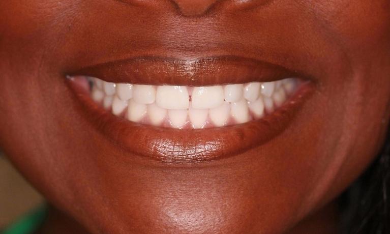 Anterior-Crowns-Part-1-Before-Image