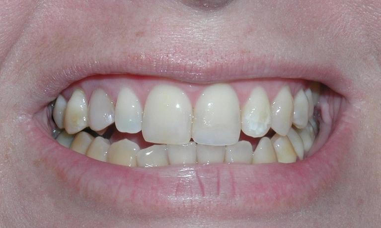 Porcelain-Veneers-Case-2-Before-Image